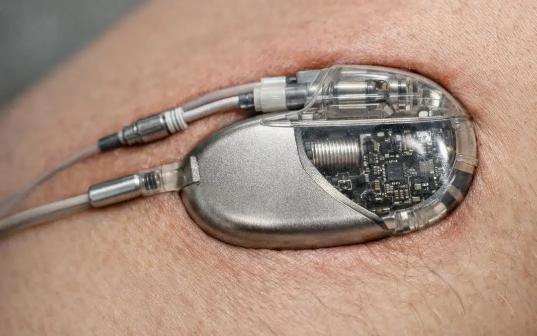 Comprendre les effets secondaires du défibrillateur implantable